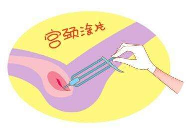 女性宫颈肥大有哪些明显症状