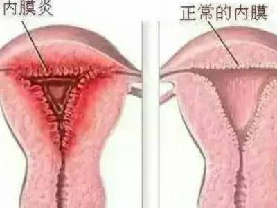 子宫内膜炎怎么治疗效果好